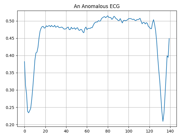 An Anomalous ECG
