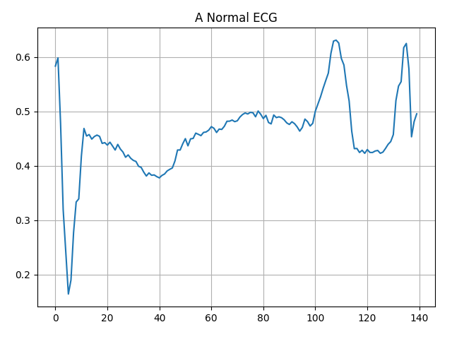 A Normal ECG